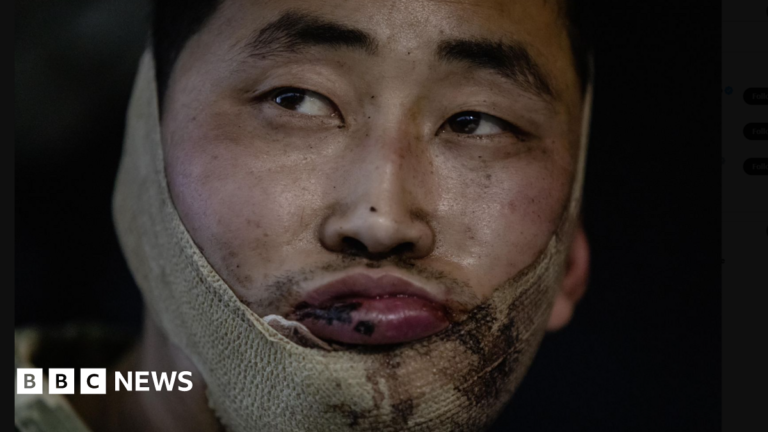 A man who is a reported North Korean prisoner of war with an injured lip and a bandage around his jaw looks off camera